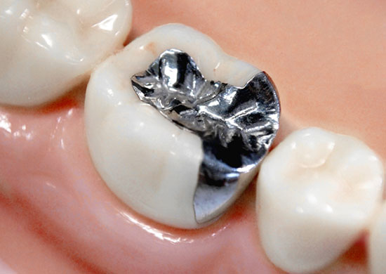 銀歯や歯の色・形が気になる人へ　～審美・セラミック治療～