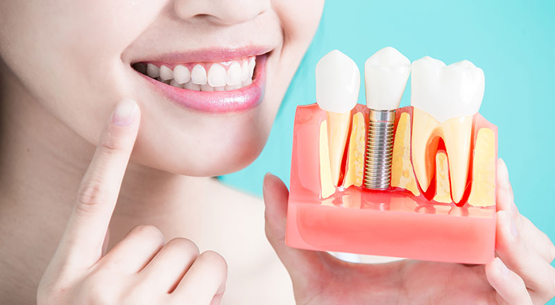 インプラントは歯を失った際の選択肢のひとつ