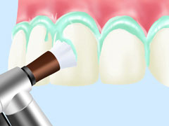 PMTC（Professional Mecanical Tooth Cleaning）