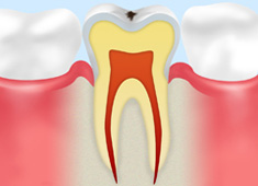 C0　初期の虫歯